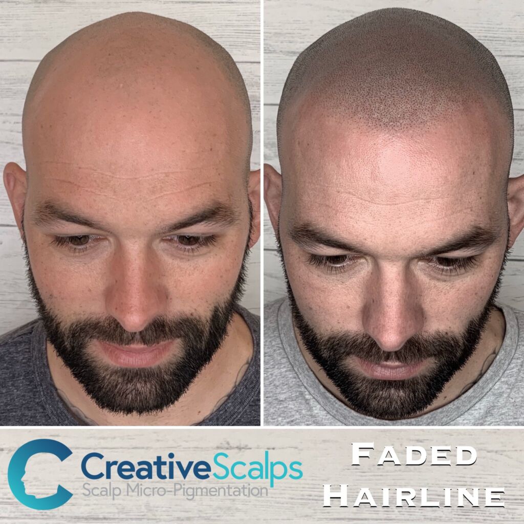 Scalp Micropigmentation - top benefits for those with hair loss